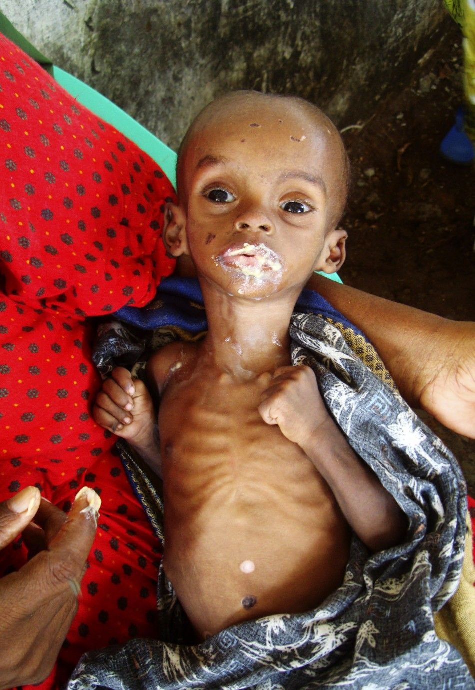 Millions of Malnourished Children in Horn of Africa are at Risk of Dying
