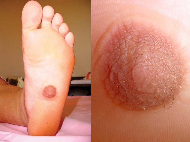 First Foot Nipple