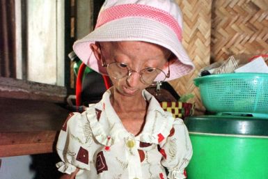 Progeria, the rapid premature aging in children