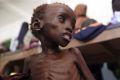 A malnourished child is seen inside a ward at Banadir hospital in Somalia&quot;s capital Mogadishu
