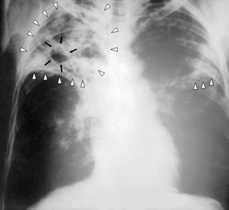 X-ray of patient with TB