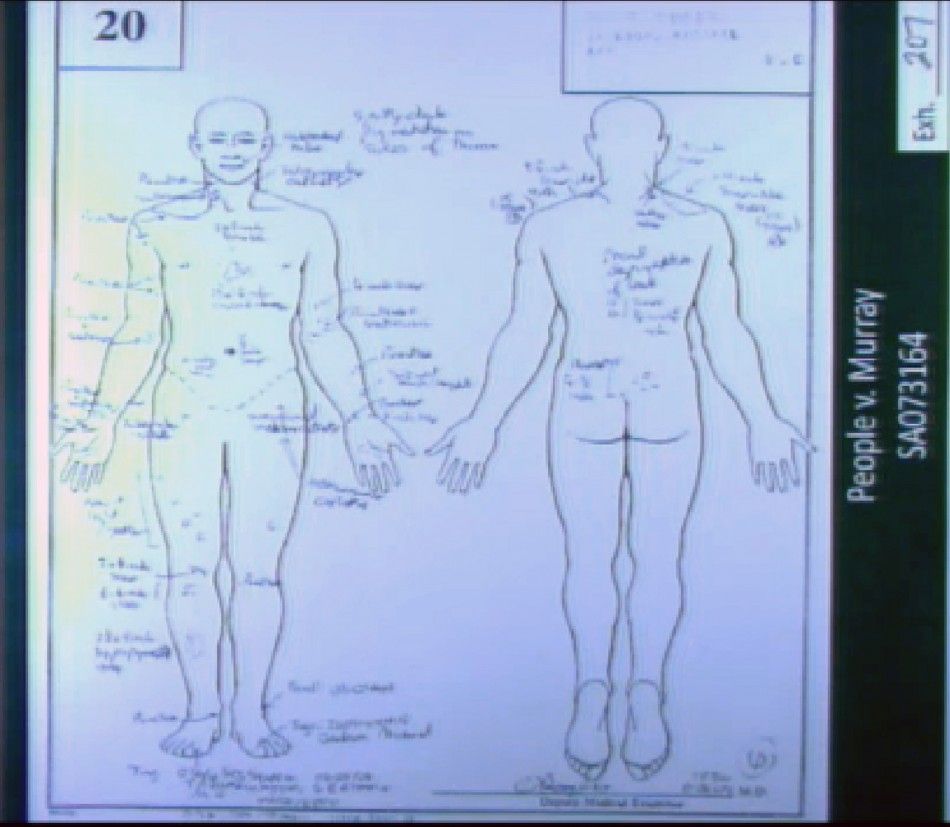 A projected chart showing the marks on Michael Jacksons body is shown as forensic pathologist Dr. Christopher Rogers testifies in Dr. Conrad Murrays trial in the death of pop star Michael Jackson in Los Angeles 