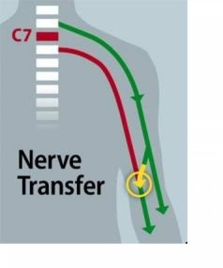 Nerve transfer