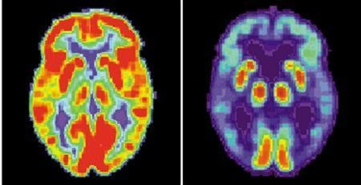 Herpes Antiviral Drugs Targeted To Delay Progression of Alzheimer Disease: Study