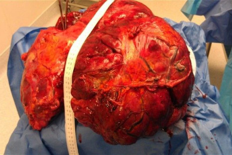 51 pound tumor