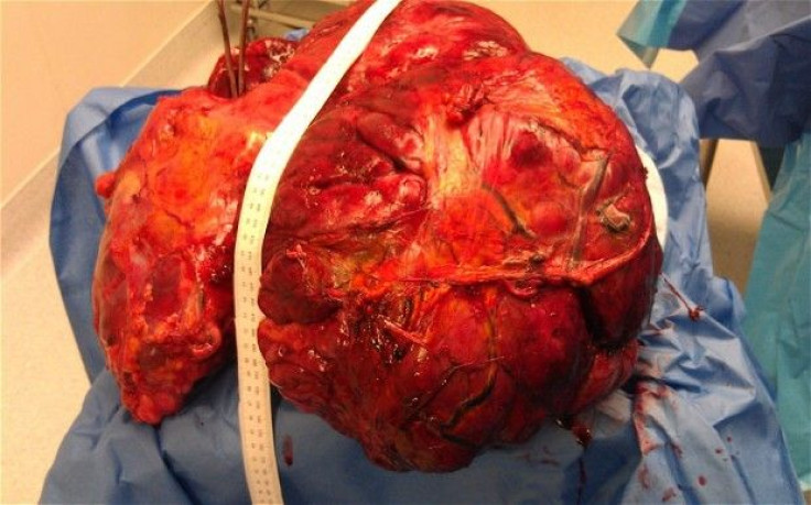 51 pound tumor