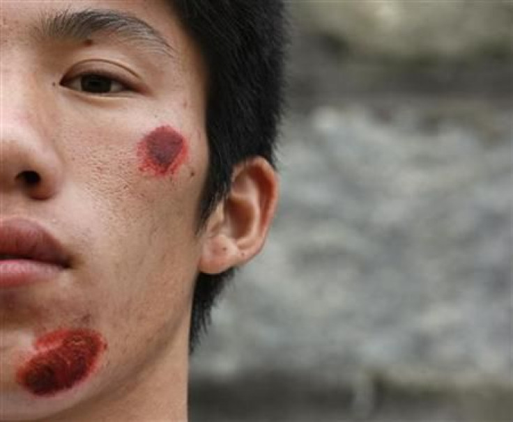 A wounded villager from Wukan is seen after a riot with the police the day earlier in Lufeng