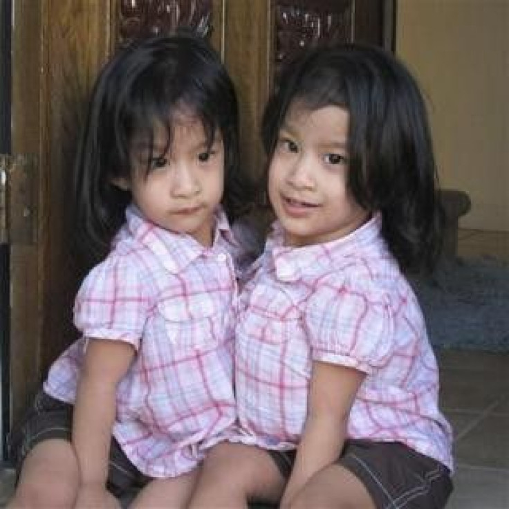 Conjoined twins Angelica and Angelina Sabuco are shown in this family photo
