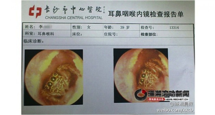 Spider Found In Ear Canal After Living Inside Woman For Days: 5 Other Bizarre Objects Found In The Human Body [PHOTOS]