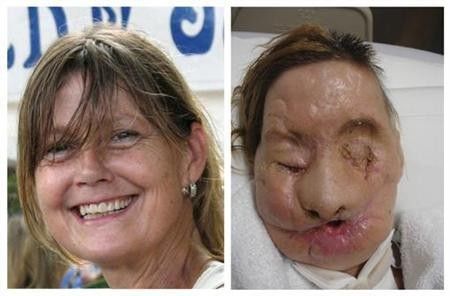 A combination photo shows face transplant recipient Charla Nash, of Stamford, Connecticut, before L and after her injury, in these undated photographs released on June 10, 2011. Nash, who was mauled by a chimpanzee in 2009, has received a full face tran