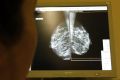 A woman undergoes a mammograms, a special type of X-ray of the breasts, which is used to detect tumours as part of a regular cancer prevention medical check-up at a clinic in Nice