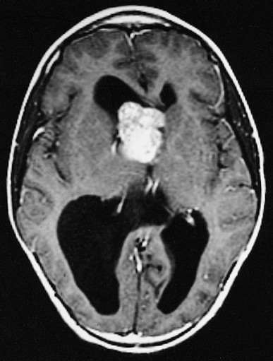 Brain