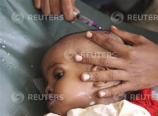 Somali doctors treat a malnourished child at Banadir hospital in Mogadishu