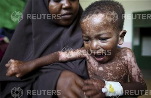 An internally displaced woman holds her malnourished son at the Banadir hospital in Somalias capital Mogadishu