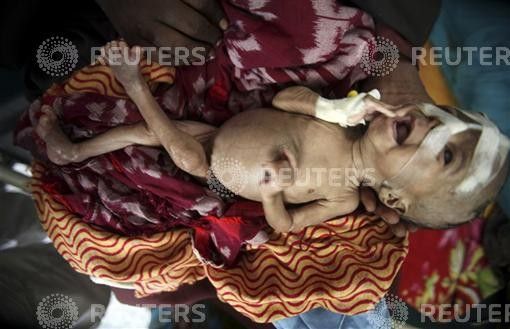 An internally displaced woman holds her malnourished son at the Banadir hospital in Somalias capital Mogadishu