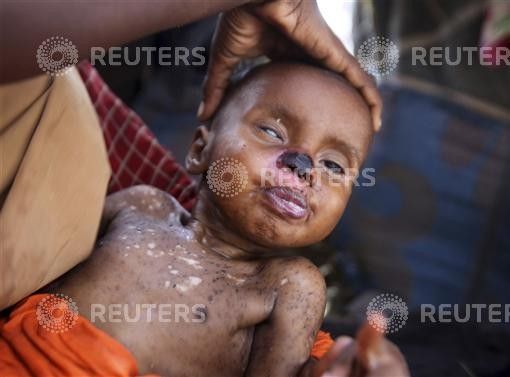 An internally displaced woman holds her malnourished son at a camp in Somalias capital Mogadishu