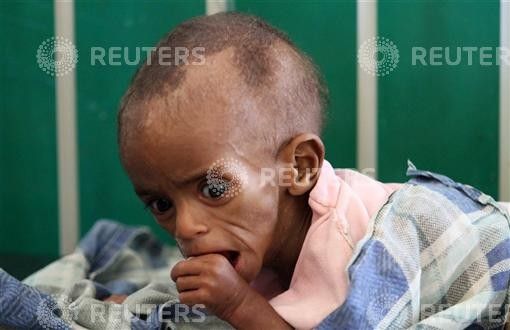 A malnourished Somali child rests inside the paediatric ward at the Banadir hospital in southern Mogadishu