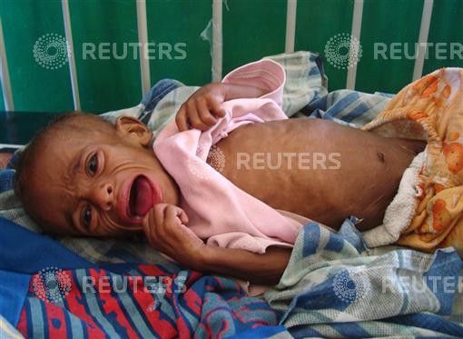A malnourished Somali child cries inside the paediatric ward at the Banadir hospital in southern Mogadishu