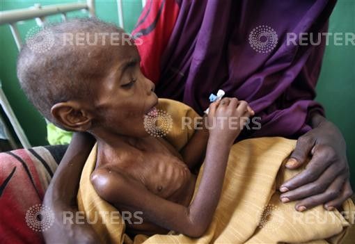 A Somali woman sits with her malnourished child at Banadir hospital in capital Mogadishu