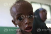 A malnourished Somali child looks into the camera inside a paediatric ward at the Banadir hospital in capital Mogadishu