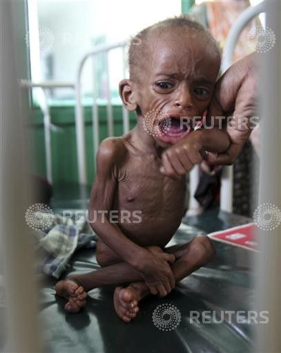 A malnourished Somali child cries inside a paediatric ward at the Banadir hospital in the capital Mogadishu