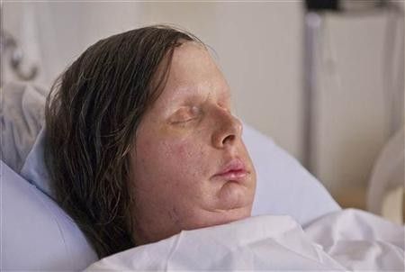 Face transplant recipient Charla Nash, of Stamford,