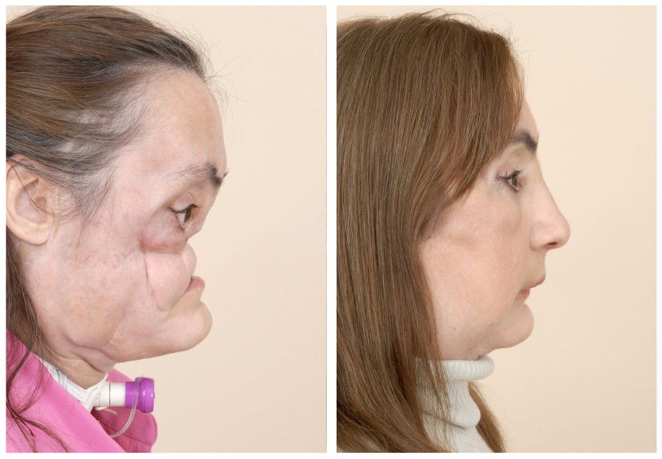 Before and After Pictures of Successful Face Transplants 