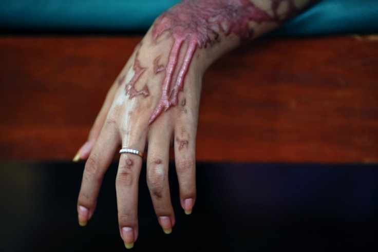 An acid attack victim