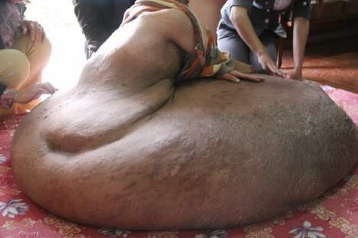 Vietnamese Man Has 200Ib Tumor Removed From Leg [PHOTOS & VIDEO]