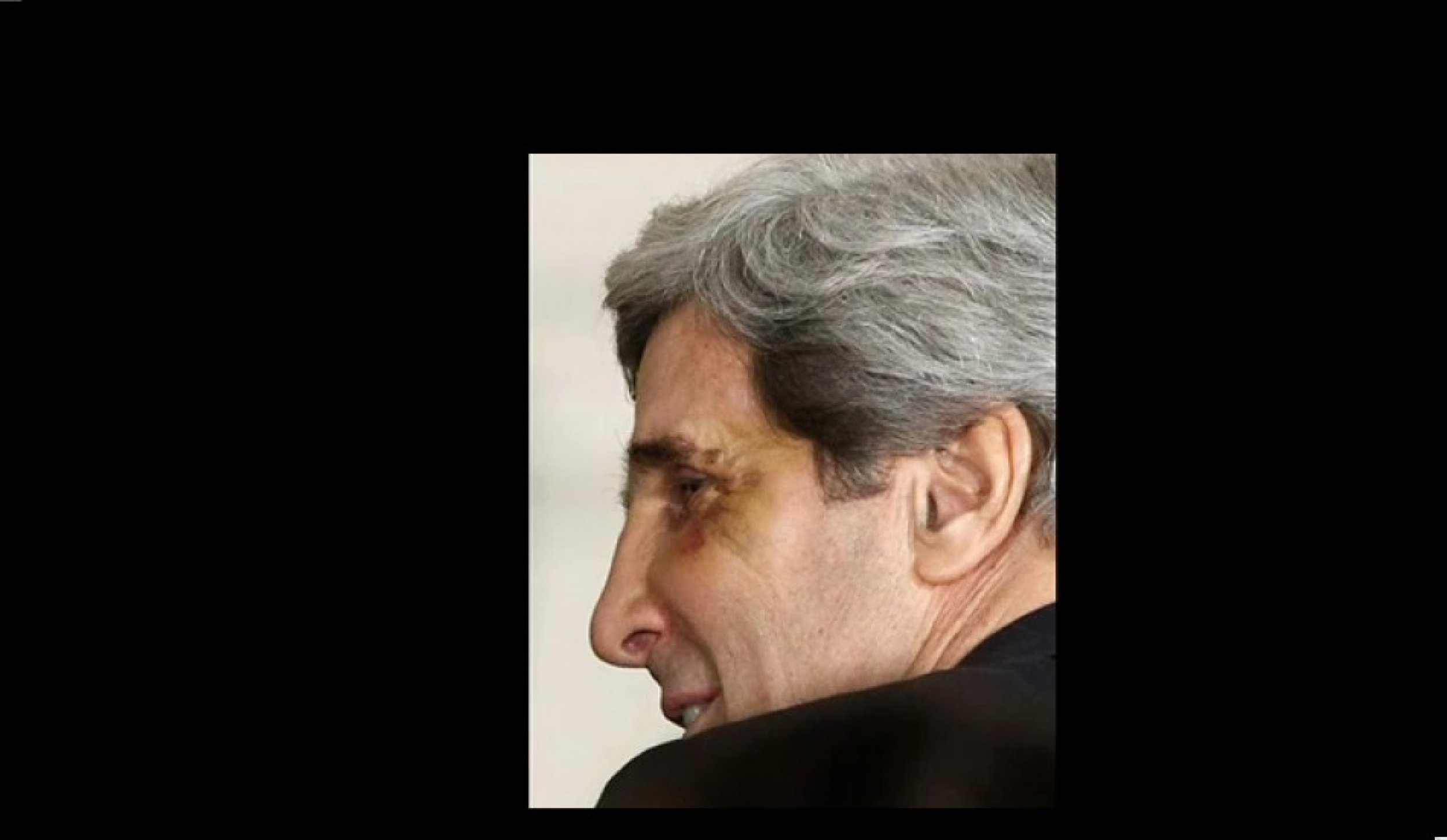 John Kerry Black Eye 1